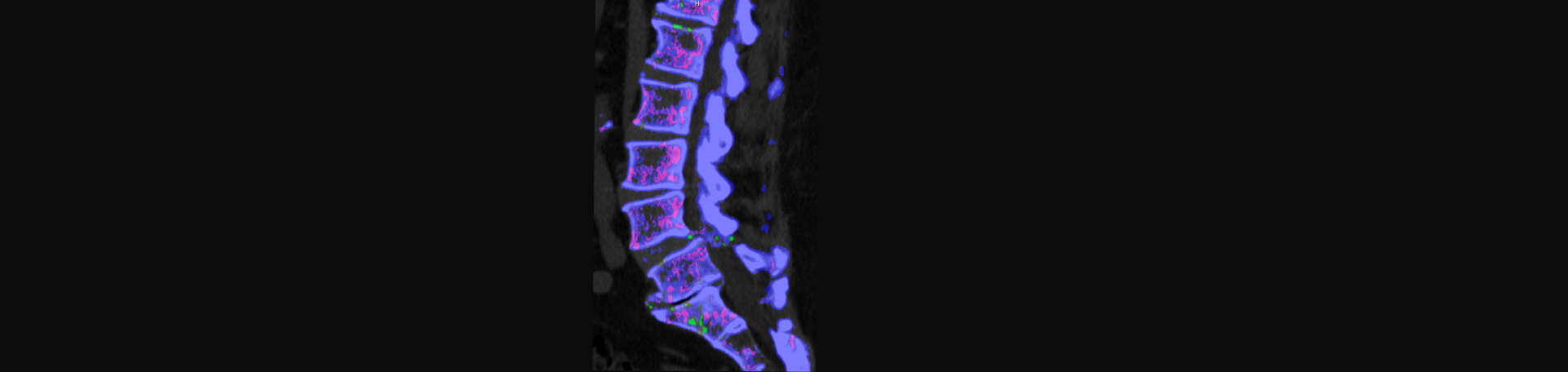 Executive Chiropractic of Iowa is aware that inflammatory spinal gout is a differential diagnosis to consider for patients who present with back pain and other spine related symptoms.