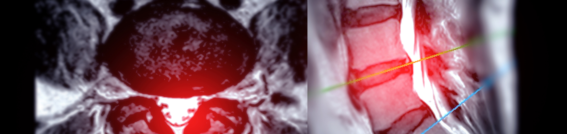 West Des Moines back pain imaging and exercise