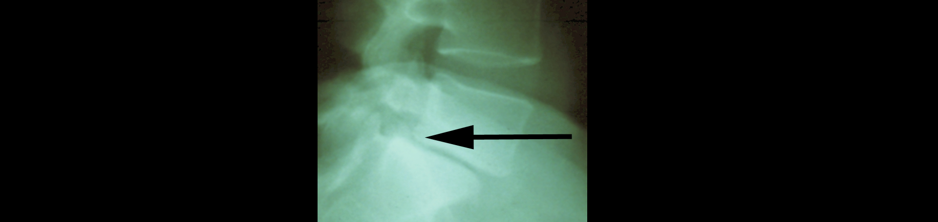 West Des Moines spondylolisthesis 