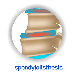 picture of West Des Moines chiropractic spondylolisthesis