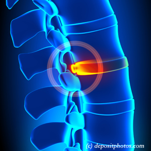 picture of lumbar West Des Moines disc herniation